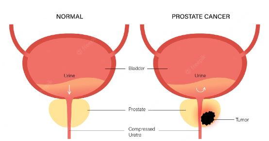 Understanding Prostate Cancer: Causes, Symptoms and Treatment Options